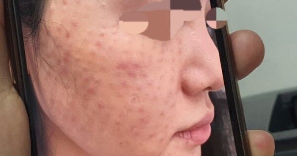 Phản ứng u hạt sau tiêm meso là gì? cách khắc phục như thế nào?